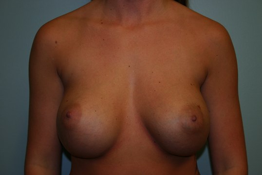 Breast revision