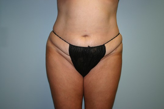 Before tummy tuck