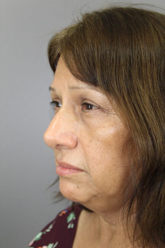 Texas Rhinoplasty